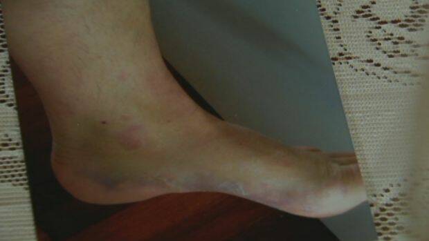 Ms Berry's ankle was stomped on by an officer. Photo: Supplied
