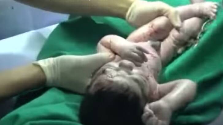 Doctors in Aleppo saved a baby girl after shrapnel that pierced her mother's belly became lodged in her forehead. Photo: Facebook