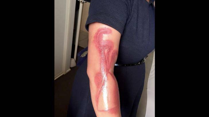 Melanie Tan Pelaez posted a picture online showing burns received after falling asleep on her charging iPhone 7. Photo: Supplied