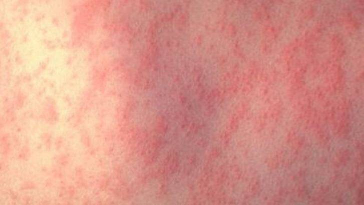 An image of the typical measles rash on a person's stomach. Photo: Centers for Disease Control and Prevention