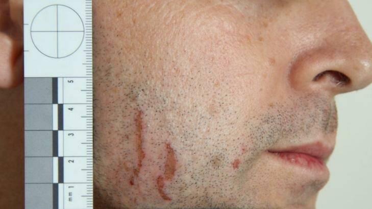 A photograph showing the scratches on Gerard Baden-Clay's face. Photo: Supplied