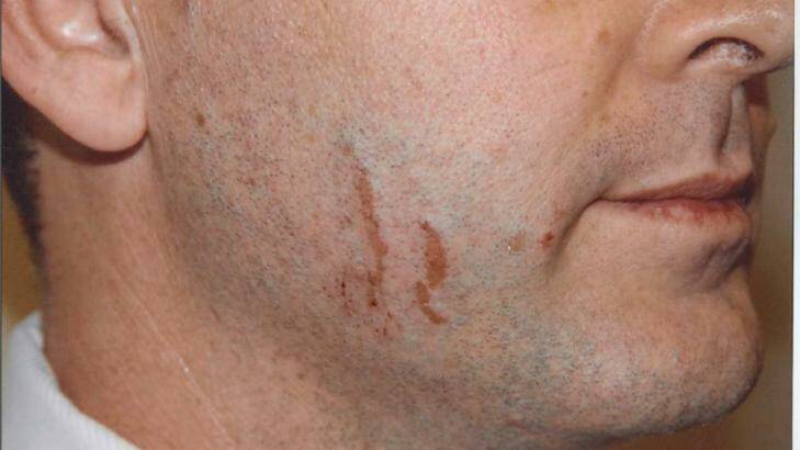 Police photographs of marks on Gerard Baden-Clay's face. Photo: Supplied