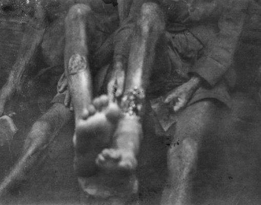 Ulcerated legs that George Beard was so terrified he may succumb to. Picture: Australian War Memorial.