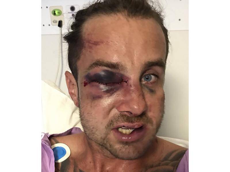 Josh Jones sustained serious facial injuries in what police say appeared an unprovoked attack.